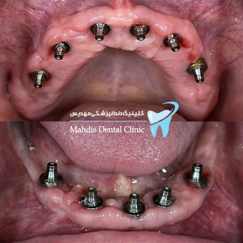 لمینت – ایمپلنت – ارتودنسی – زیبایی دندان در غرب تهران